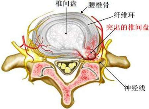 我们腰间盘突出做什么赚钱 得了腰椎间盘突出做什么工作维持生活?