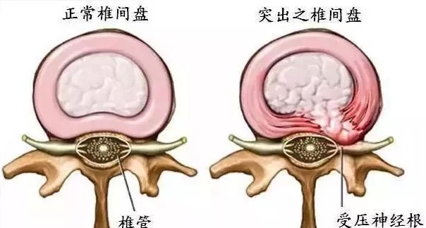 我们腰间盘突出做什么赚钱 得了腰椎间盘突出做什么工作维持生活?