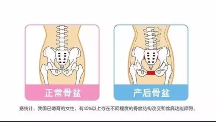 随州产后骨盆恢复加盟项目，重塑美丽新妈妈