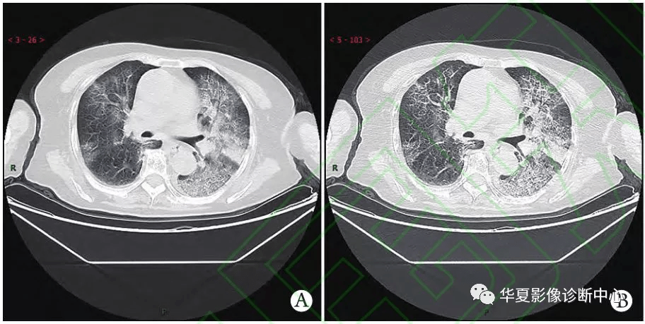 新冠病毒肺炎肺部变化图 新冠病毒肺炎肺部变化图解