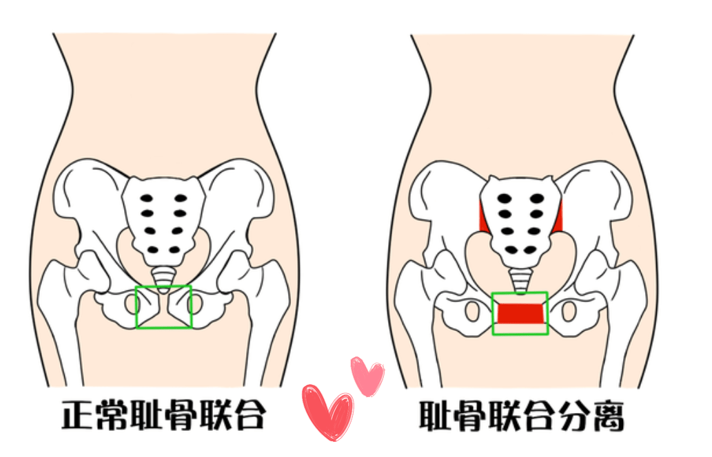 孕妇为什么耻骨疼 孕妇为什么耻骨疼晚上更明显