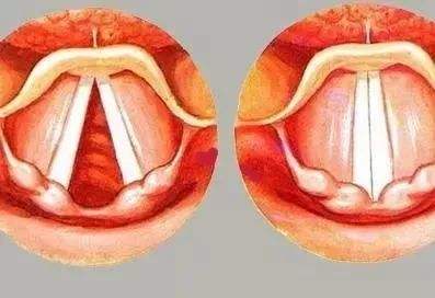 气泡音转高音时声带合不合的简单介绍