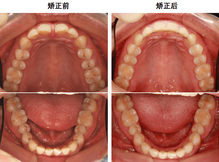 门牙内凹运势(门牙凹凸不平会影响运势吗)