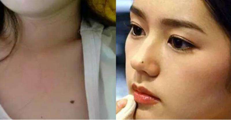 肚子有痣运势(肚子痣代表什么)