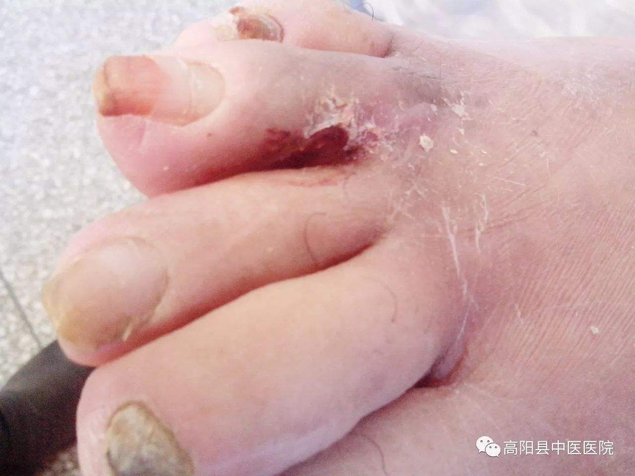 糖尿病银合不合(银屑病和糖尿病同时都有应该怎么注意)