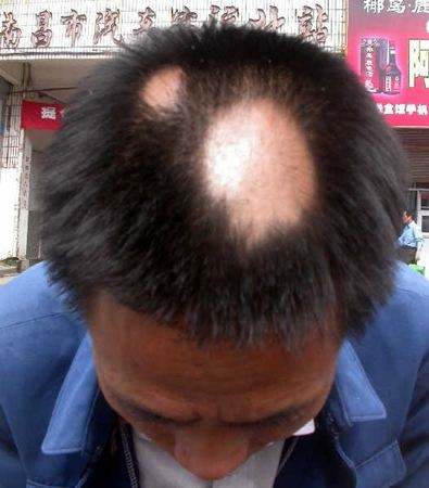 脱发人的运势(容易脱发的八字)